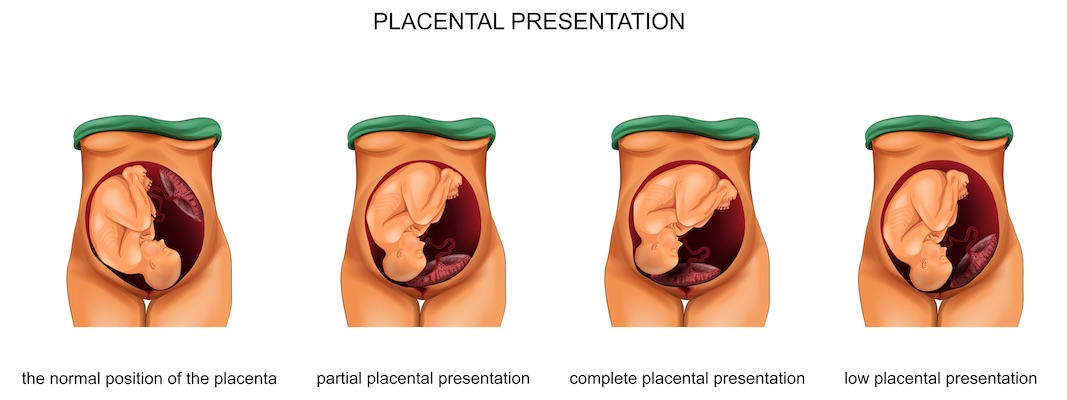 placenta previa Test de OPE Matronas